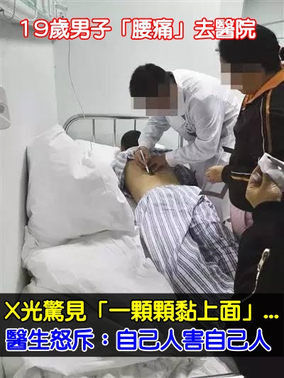 不敢置信！19歲男子因「腰痛」去醫院拍片　X光下驚見「一顆一顆黏在上面」醫生無奈：自己人害自己人