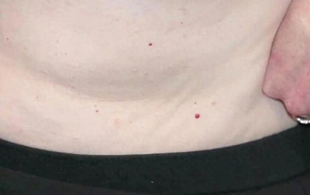 人不會無緣無故長紅痣！醫生警告：可能潛藏這3種疾病
