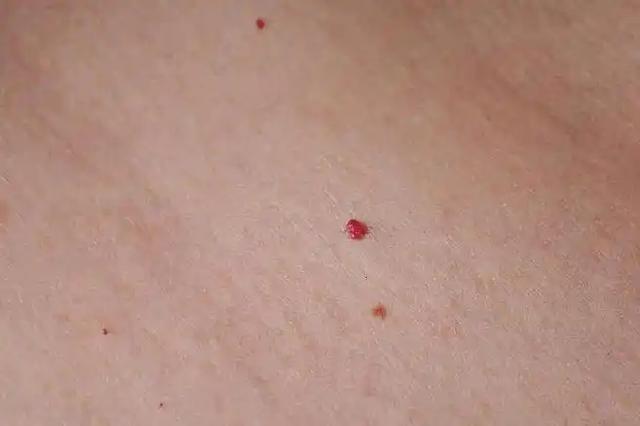 人不會無緣無故長紅痣！醫生警告：可能潛藏這3種疾病