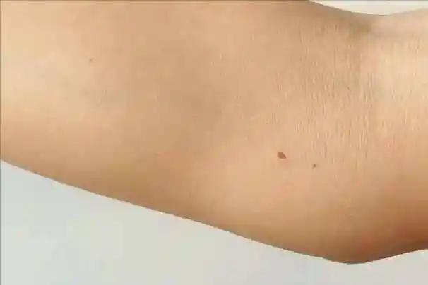 人不會無緣無故長紅痣！醫生警告：可能潛藏這3種疾病