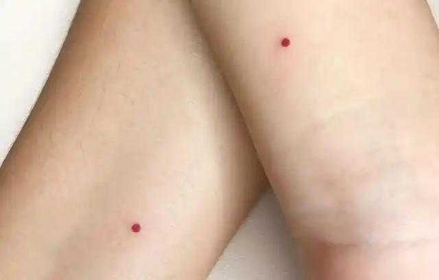 人不會無緣無故長紅痣！醫生警告：可能潛藏這3種疾病