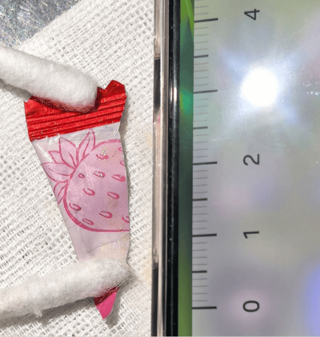6歲娃突咳血送醫！照電腦斷層「醫師看傻」：肺裡怎會有這個？