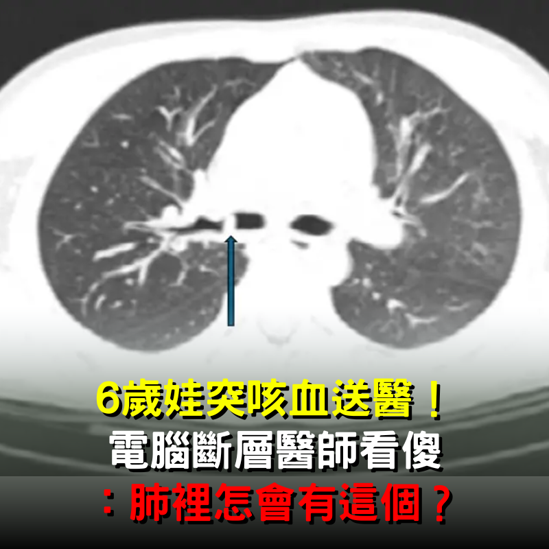 6歲娃突咳血送醫！照電腦斷層「醫師看傻」：肺裡怎會有這個？