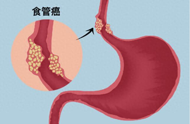 感覺吞嚥困難...這癌症「清一色只找男性」　醫警告：常見3習慣「小心養出癌」
