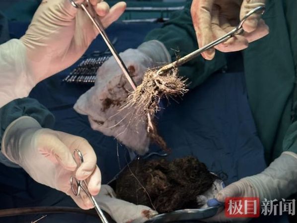 以為只是吃壞肚子！15歲少女「腹痛臉色慘白」急送醫　肚子「竟見長頭髮石頭」
