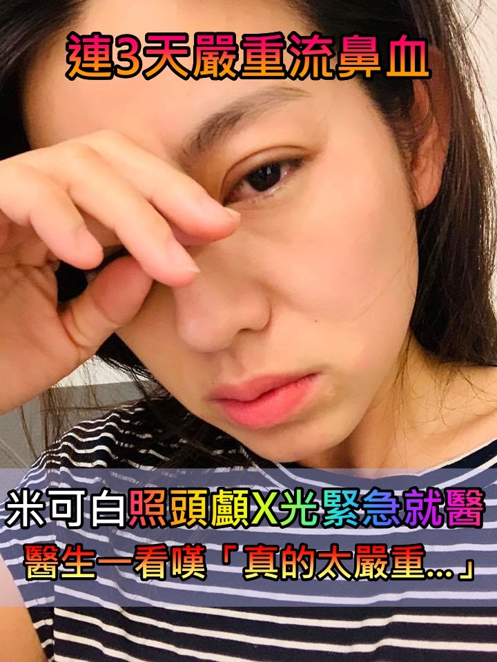 連續3天流鼻血！米可白「緊急送醫照頭顱X光」　醫生嘆「真的太嚴重」將動手術治療