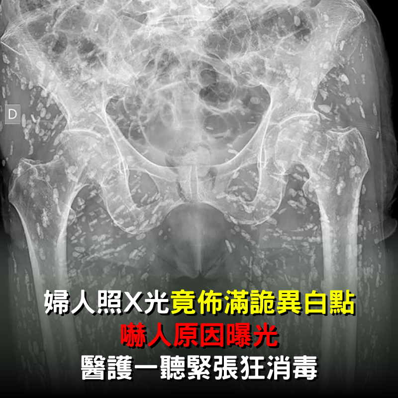 婦人照X光竟「佈滿詭異白點」！「嚇人原因曝光」醫護一聽緊張狂消毒