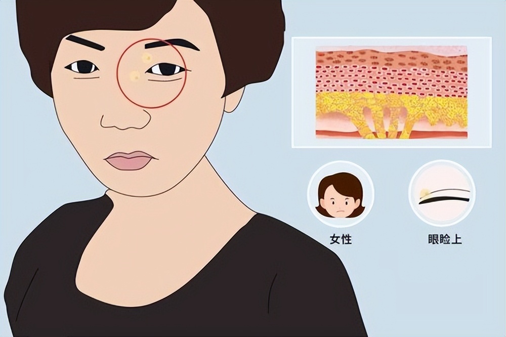 皮膚上長出「這東西」，說明你的血脂太高！再不注意會有生命危險
