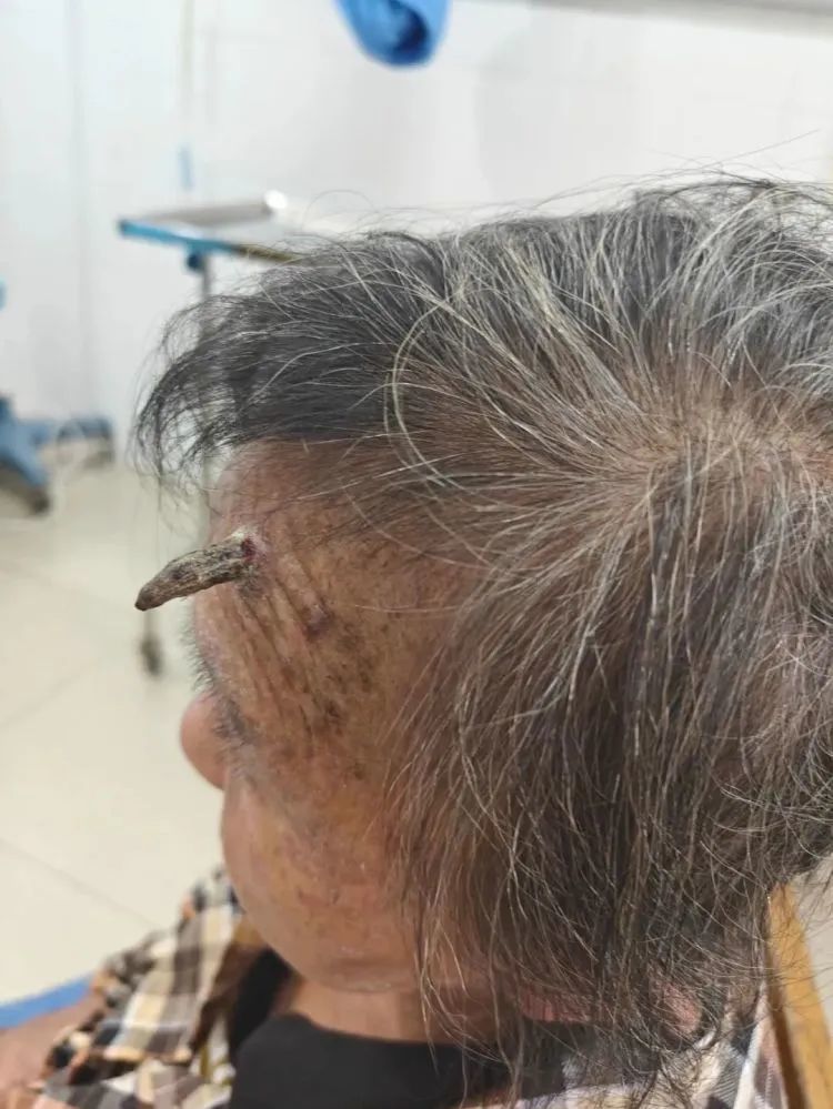 98歲老奶奶「頭上長怪角」自己拿剪刀剪掉！　大出血「送醫險命危」醫：長輩尤其要注意