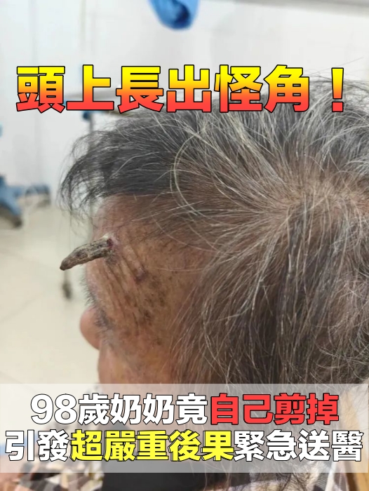 98歲老奶奶「頭上長怪角」自己拿剪刀剪掉！　大出血「送醫險命危」醫：長輩尤其要注意
