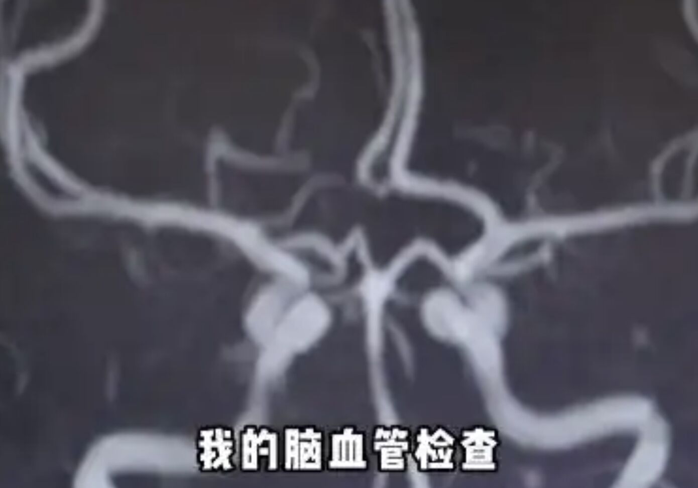 癱倒手術台前！45歲腦梗權威自爆「我也腦梗了」　不菸不酒「唯一病因曝光」：年輕人也會遇到...