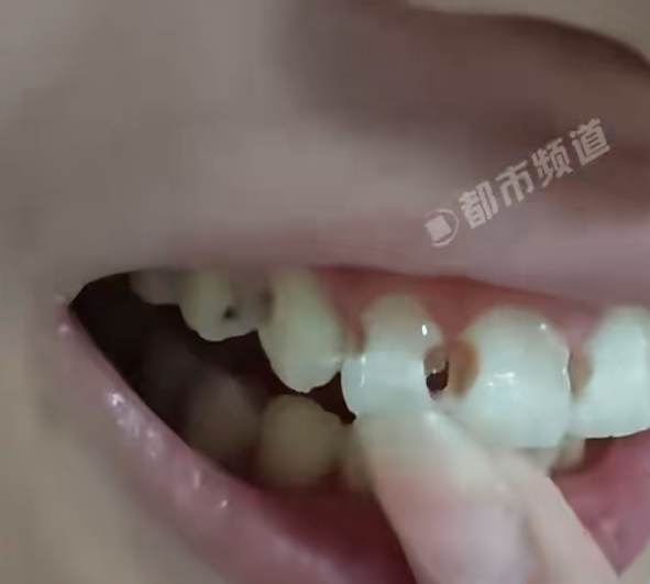 明明早晚都有刷牙！她5年爛8顆牙「嚴重蛀成洞」　醫生曝「她少做一件事」：怎能這樣搞？