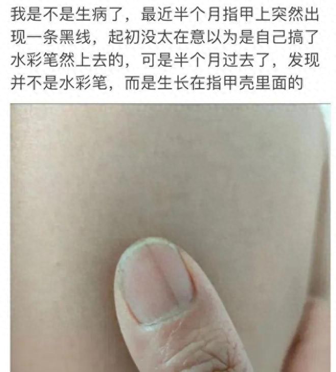 千萬要小心！指甲出現1變化，可能是癌變！
