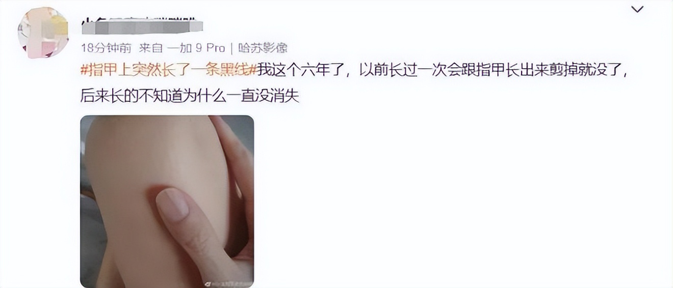千萬要小心！指甲出現1變化，可能是癌變！