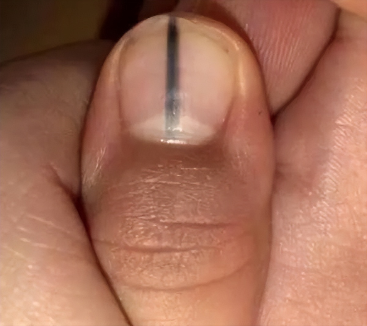 千萬要小心！指甲出現1變化，可能是癌變！