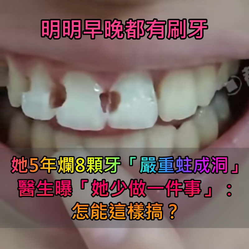 明明早晚都有刷牙！她5年爛8顆牙「嚴重蛀成洞」　醫生曝「她少做一件事」：怎能這樣搞？
