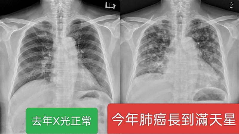 每年健檢都正常！50歲男最後「肺部照出滿天星」末期了　醫生感慨「做錯項目了」：被斷活路