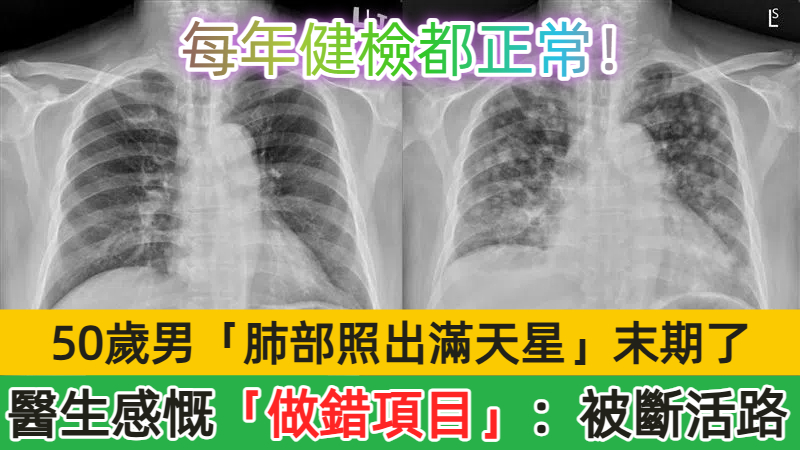 每年健檢都正常！50歲男最後「肺部照出滿天星」末期了　醫生感慨「做錯項目了」：被斷活路