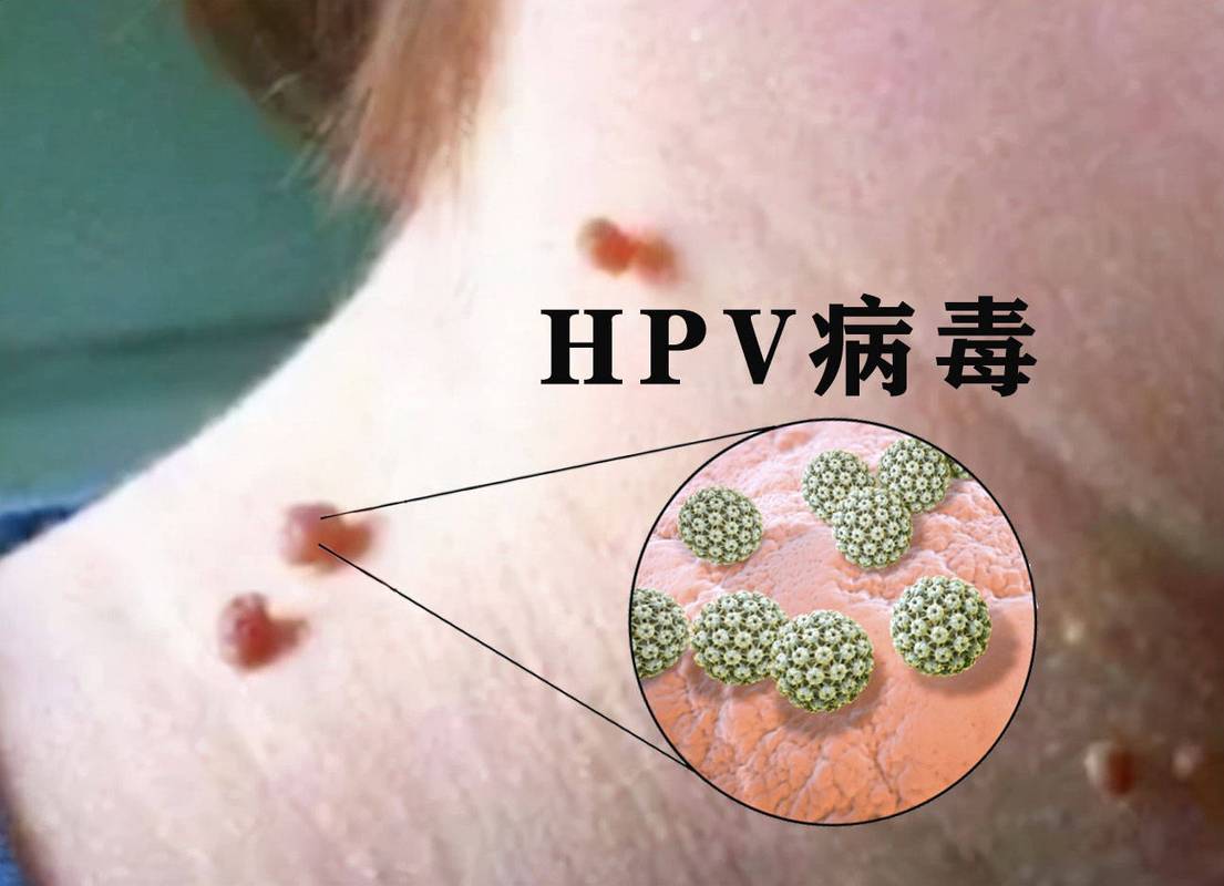 以為是過敏！生活規律夫妻卻「雙雙查出HPV」崩潰　醫生直言：5種行為是「幫凶」