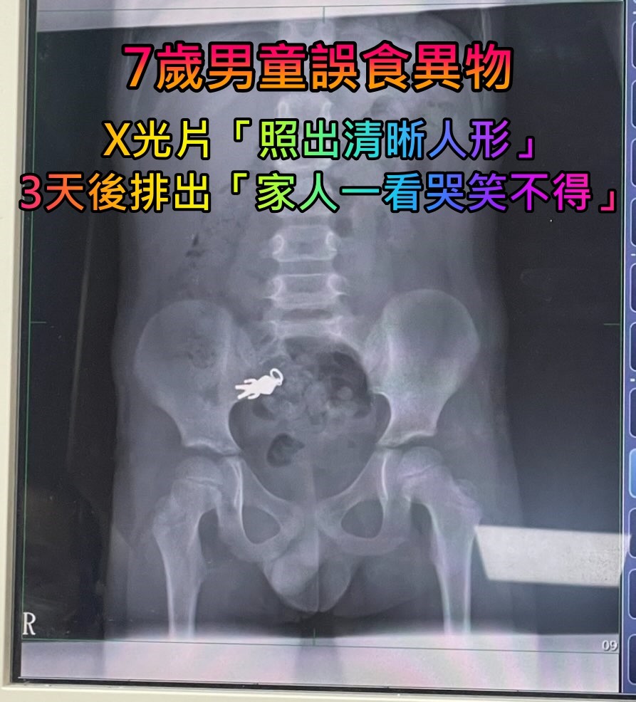 7歲童吃東西誤吞！X光片「清晰可見完整人形」　 3天後拉出「家人一看哭笑不得」