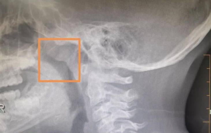 身體有癌，耳朵先知！耳朵「出現3個異常」暗示癌症來敲門了