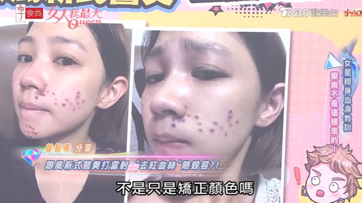 跟風醫美!陳志強老婆「漂亮臉蛋爛掉」照片曝光 她崩潰吼:「醫生不老實」