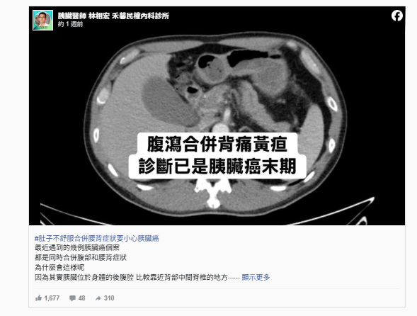 59歲坣娜病逝!醫揭胰臟癌「唯一早期徵兆」:50歲以上要特別注意