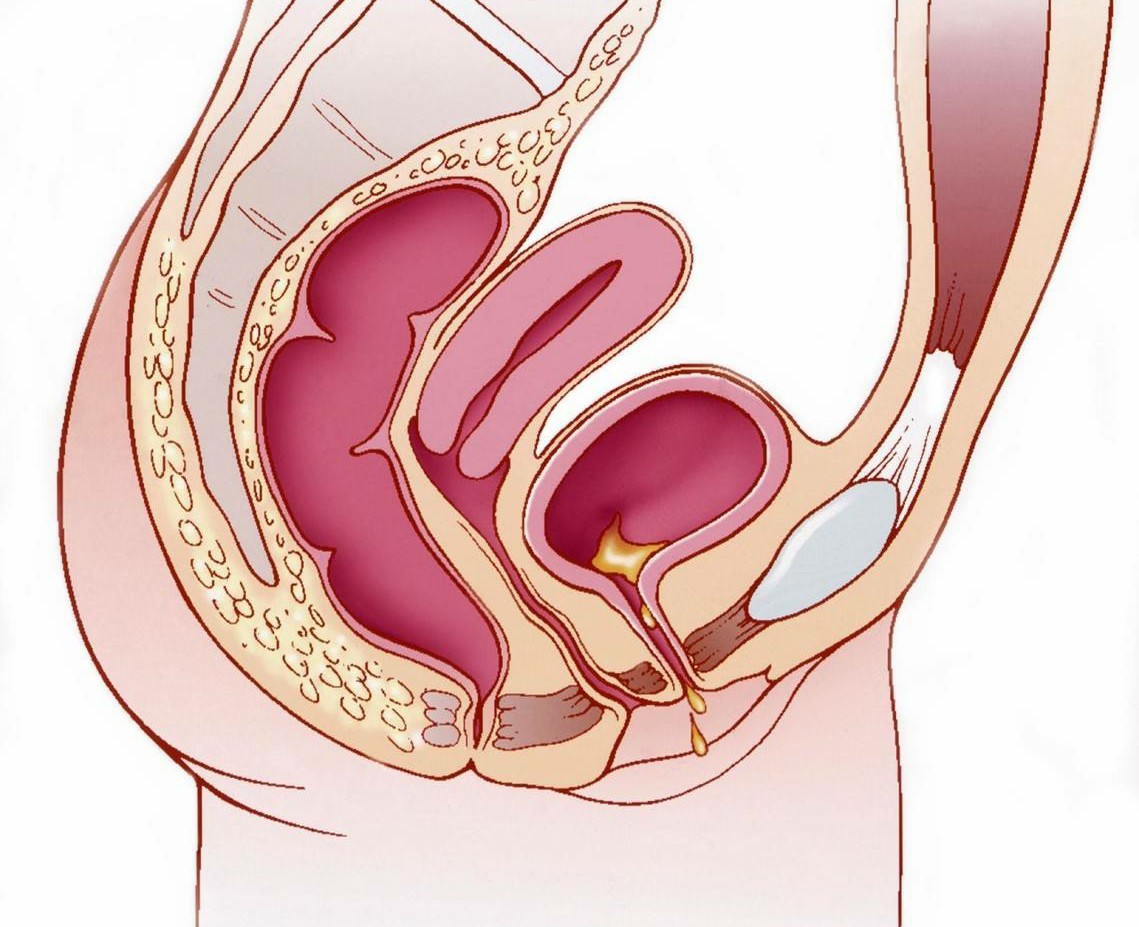 摘子宮後狂漏尿!44婦女淚控切除後「胃和膀胱掉下來」引發後遺症 醫揭真相「問題出在它」