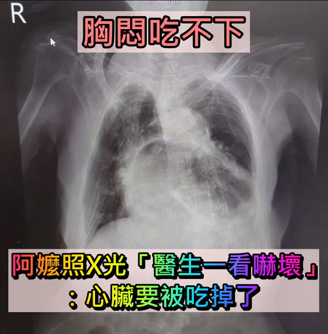 胸悶吃不下!阿嬤照X光「胃部位置怪怪的」嚇壞:吃掉心臟了 揭病因「非短時間造成」再拖恐癌變