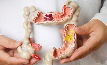 大腸癌年輕化！「台灣7.8年級生」罹腸癌風險最高　醫證實「2關鍵害的」快戒掉：老年人反而沒有