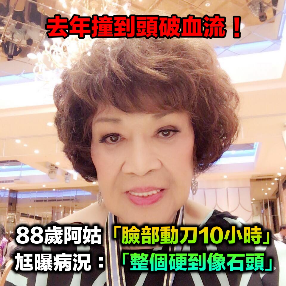 88歲阿姑驚傳「臉部動刀10小時」!最新病況曝光...