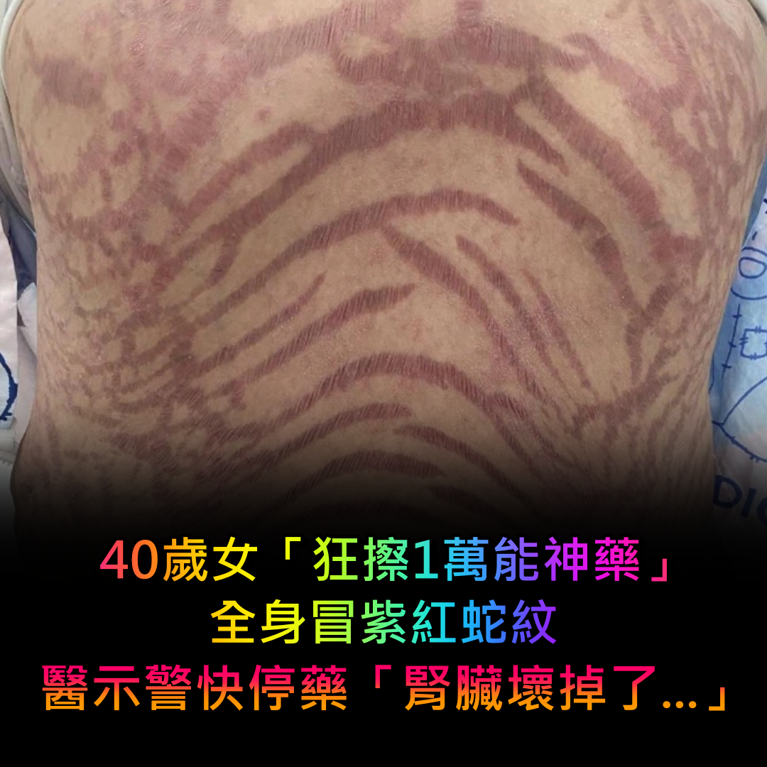 40歲女狂擦「1萬能神藥」全身冒蛇紋!醫生一看臉綠「腎臟壞掉了」:快停藥