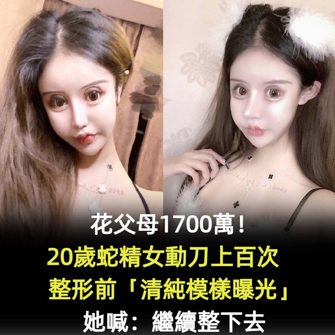 整容上癮!20歲蛇精女「花父母1700萬」動刀上百次 整前「清純模樣曝光」她喊:開心就好