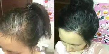 掉髮元凶找到了！研究發現「常喝2大飲品」落髮機率大增　多補充「一關鍵營養」保住年輕秀髮