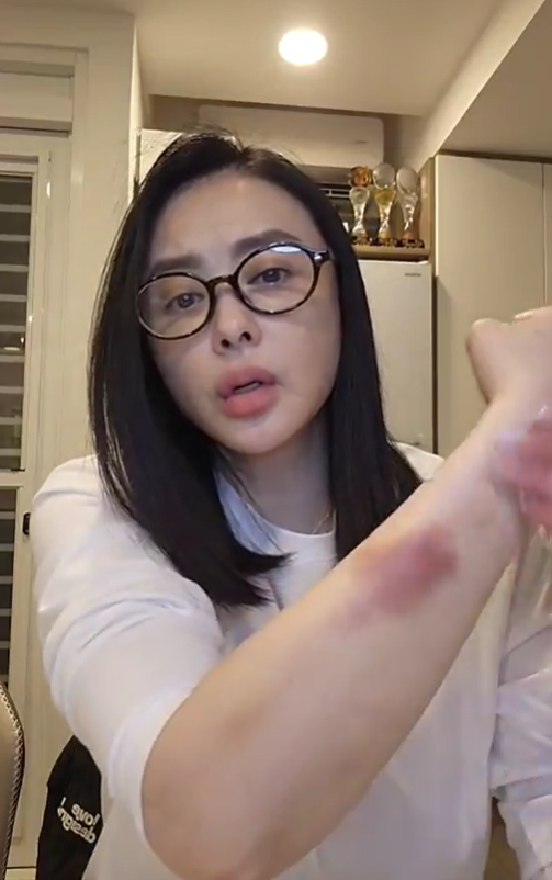 嫁小15歲尪！蕭淑慎結婚8周年「鏡頭前曬全身瘀青」　疑遭家暴她嘆：「不停問自己發生什麼？」