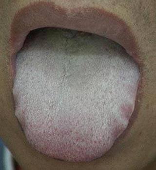 舌頭是健康儀表板!「舌頭5異常」是身體在求救 「尤其一狀況」小心已罹癌:準確率高達98%