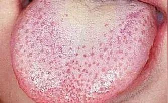 舌頭是健康儀表板!「舌頭5異常」是身體在求救 「尤其一狀況」小心已罹癌:準確率高達98%