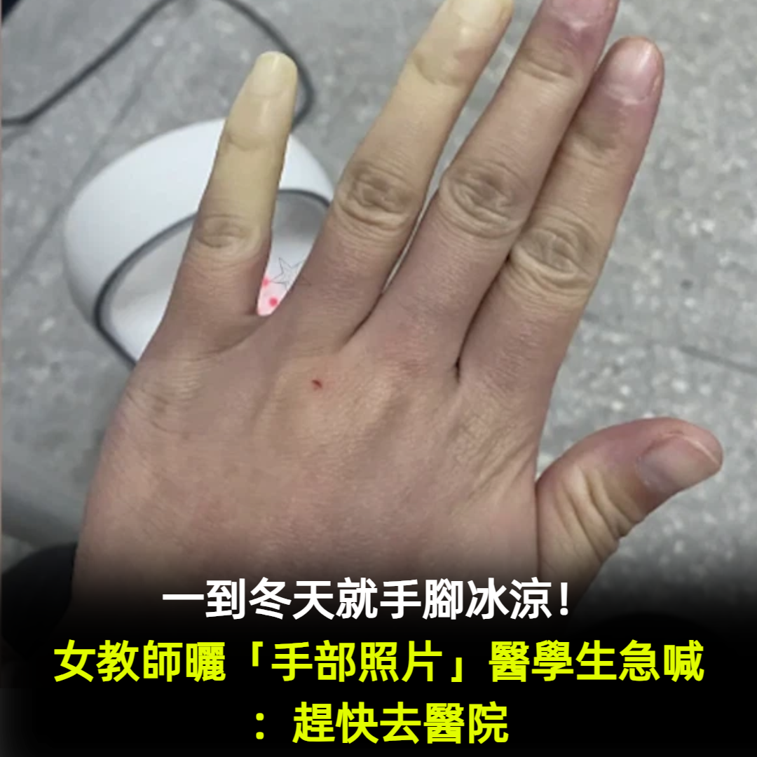 一到冬天就手腳冰涼!女教師曬「手部照片」抱怨 「醫學生一看」連忙喊話:趕快去醫院