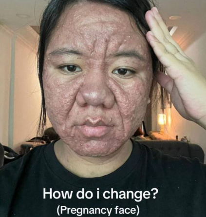 因懷孕容貌大變！28歲準媽媽崩潰「變成60歲阿嬤」　公開「原本清秀模樣」：為什麼是我...