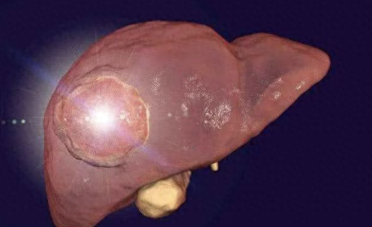 不菸不酒又強壯！年輕男肩膀痛「推拿復健都沒用」　一照是「10公分腫瘤已癌末」醫：僅一招可保命