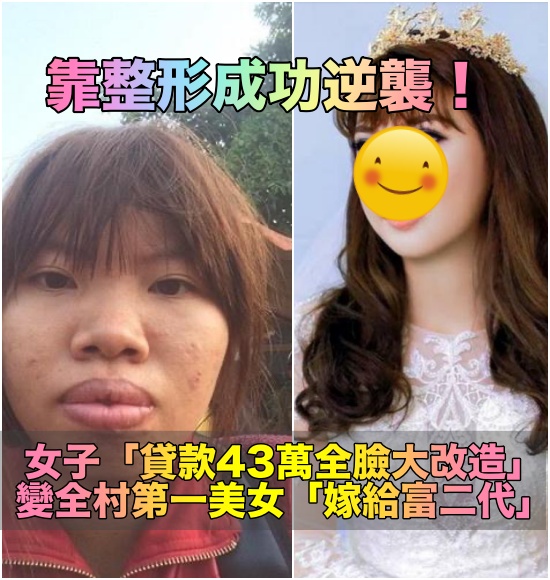 逆襲人生！她「天生爆唇被嫌醜」狠花43萬整形　1年後美翻「網封第一美女」爽嫁富二代