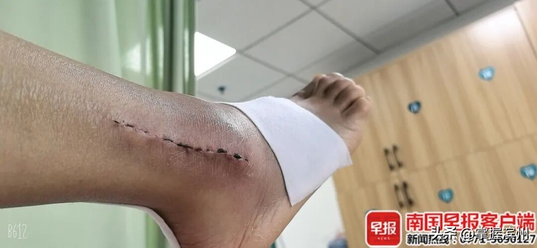 才剛進電梯!婦人「重傷被救出」 搶回小命「治療10個月」原因曝光