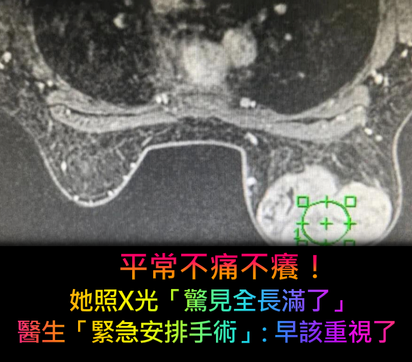 平常不痛不癢!她照X光「驚見全部長滿了」 醫生臉綠「緊急安排手術」:早該重視了