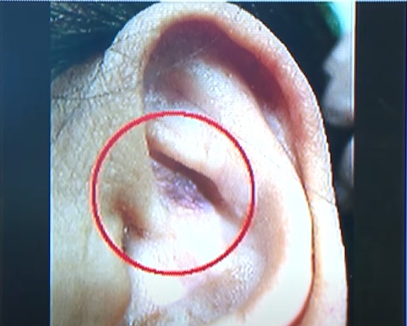 一年7000人大腸癌過世！醫示警　「耳朵、臉出現1徵兆」趕快就醫