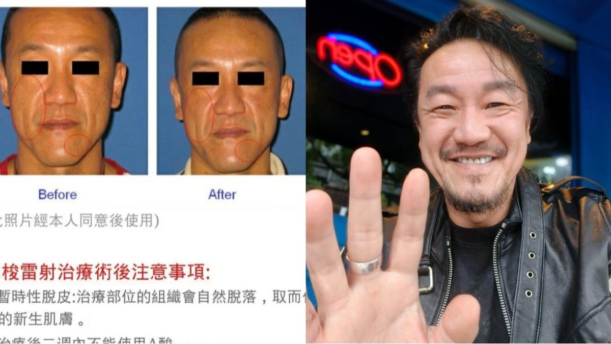 醫美打馬仍被認出!網一看秒喊「61歲演藝圈大哥」他出面認了