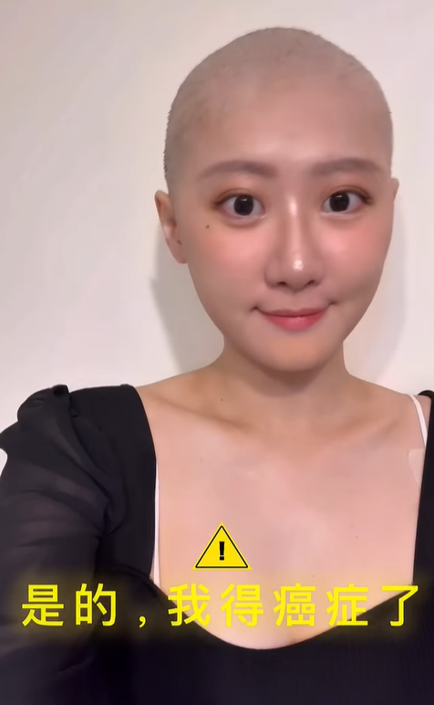 化療暴肥12公斤!本土女神「摘假髮證實罹癌」 痛揭「收入慘跌5倍」:已不是從前的自己