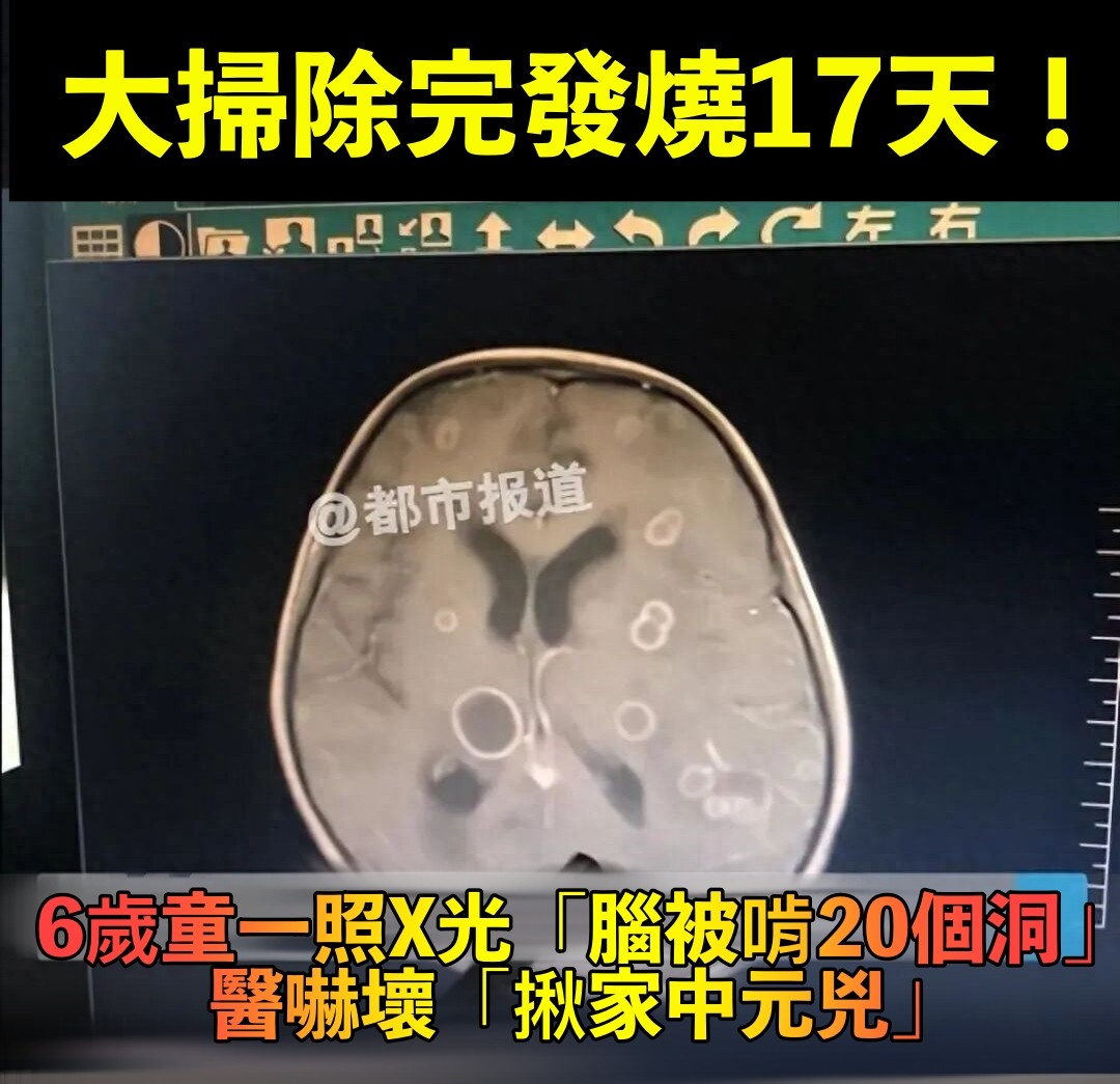 過年前大掃除後！6歲女孩「連續發燒17天」　緊急送醫「腦被啃出20多洞」醫嚇壞：再晚就來不及