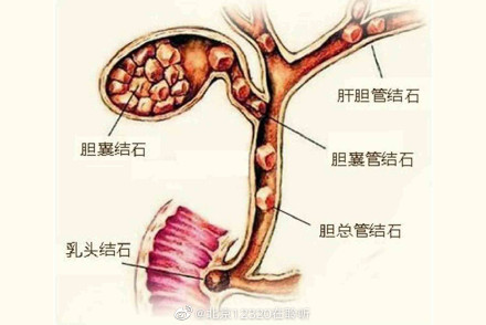 潛伏10年之久！女子健康檢查「體內竟取出700顆」　醫警告「嚴重恐癌變」：有4徵兆馬上開刀