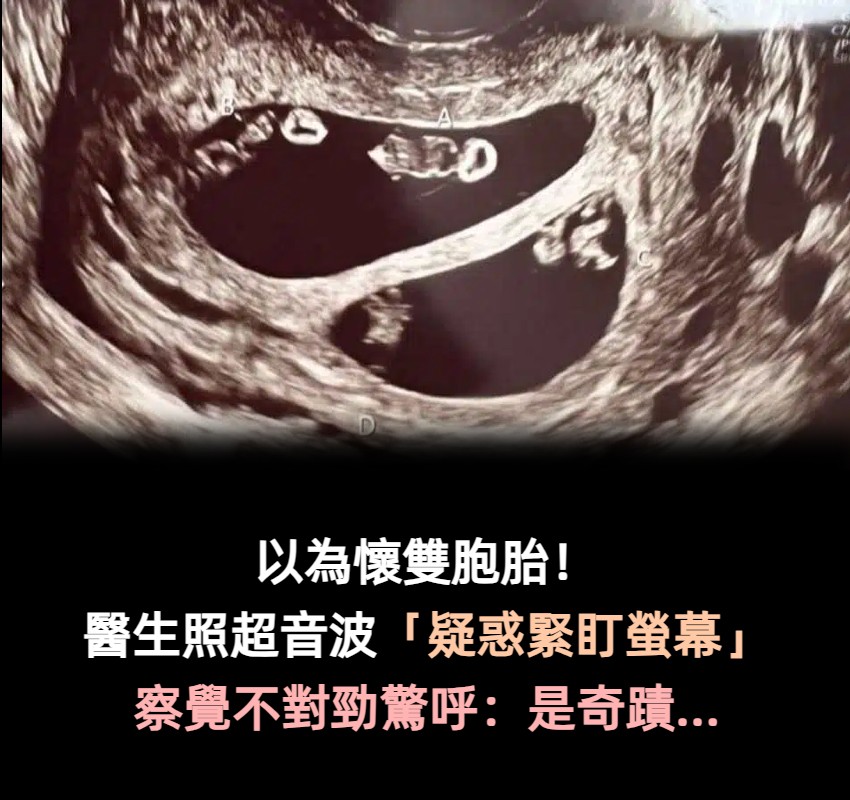 以為是懷雙胞胎！醫生幫她照超音波「疑惑緊盯螢幕」　走出房間驚呼「千萬分之1的奇蹟」全場嚇傻