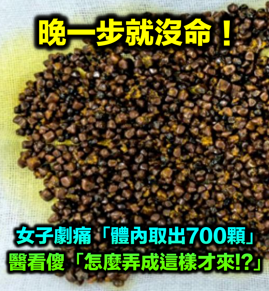 潛伏10年之久！女子健康檢查「體內竟取出700顆」　醫警告「嚴重恐癌變」：有4徵兆馬上開刀